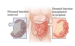 Intestinal Transplant in Delhi India