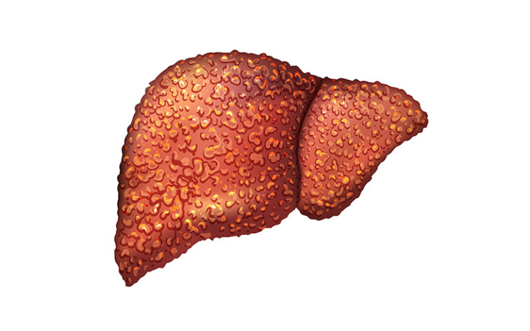 How To Start Your Liver Cirrhosis Treatment? | Dr. Naimish Mehta